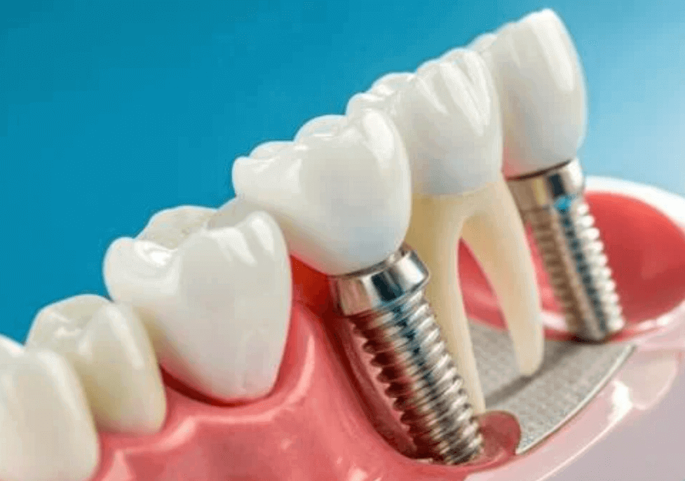 dental implants