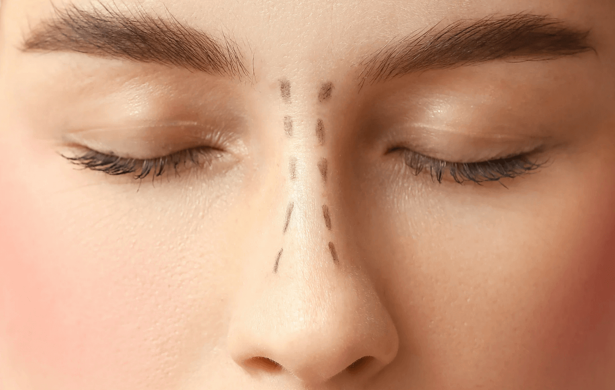 rhinoplasty for mothers