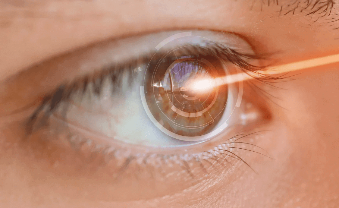laser vision correction