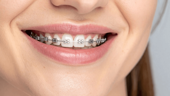 cost of braces in Singapore