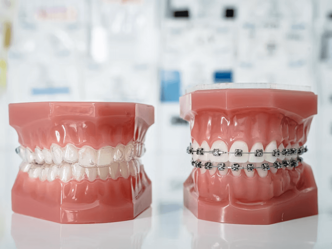 Tooth model with dental braces